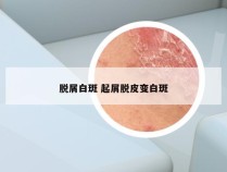 脱屑白斑 起屑脱皮变白斑