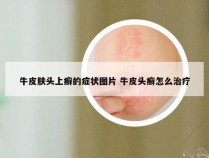 牛皮肤头上癣的症状图片 牛皮头癣怎么治疗