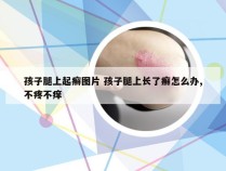 孩子腿上起癣图片 孩子腿上长了癣怎么办,不疼不痒