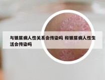 与银屑病人性关系会传染吗 和银屑病人性生活会传染吗