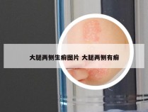 大腿两侧生癣图片 大腿两侧有癣