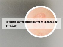 干燥综合症打生物制剂要打多久 干燥综合症打什么针