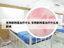 生物制剂是治疗什么 生物制剂是治疗什么皮肤病