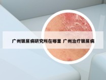 广州银屑病研究所在哪里 广州治疗银屑病