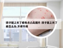 孩子腿上长了癣有点凸出图片 孩子腿上长了癣怎么办,不疼不痒