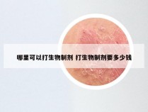 哪里可以打生物制剂 打生物制剂要多少钱