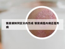 银屑病如何区分内热或 银屑病是内病还是外病