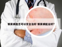 银屑病是否可以完全治好 银屑病能冶好?