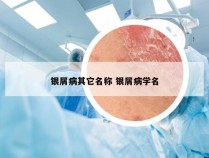 银屑病其它名称 银屑病学名