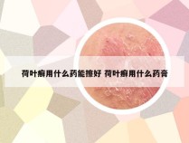 荷叶癣用什么药能擦好 荷叶癣用什么药膏