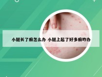 小腿长了癣怎么办 小腿上起了好多癣咋办