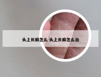 头上长癣怎么 头上长癣怎么治