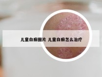 儿童白癣图片 儿童白癣怎么治疗