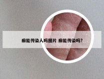 癣能传染人吗图片 癣能传染吗?