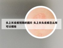 头上长皮癣初期的图片 头上长头皮癣怎么样可以根除