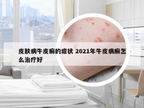 皮肤病牛皮癣的症状 2021年牛皮病癣怎么治疗好