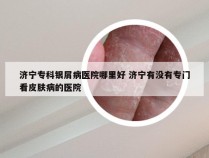 济宁专科银屑病医院哪里好 济宁有没有专门看皮肤病的医院