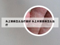 头上银癣怎么治疗最好 头上长银屑癣怎么治疗