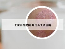 土法治疗皮癣 用什么土法治癣