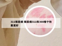 311银屑病 银屑病311和308哪个效果更好