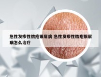 急性发疹性脓疱银屑病 急性发疹性脓疱银屑病怎么治疗