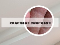 皮肤癣红霉素软膏 皮癣用红霉素软膏