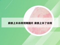 肩膀上长白斑初期图片 肩膀上长了白斑