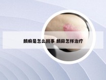 麟癣是怎么回事 麟藓怎样治疗