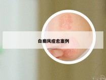 白癜风痊愈案例