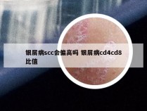 银屑病scc会偏高吗 银屑病cd4cd8比值