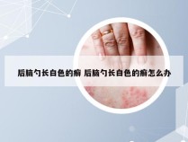 后脑勺长白色的癣 后脑勺长白色的癣怎么办