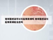 链球菌感染可以引起银屑病吗 链球菌感染引起银屑病能治愈吗