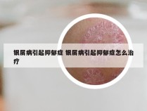 银屑病引起抑郁症 银屑病引起抑郁症怎么治疗