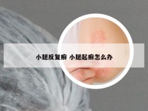 小腿反复癣 小腿起癣怎么办