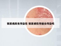 银屑病具有传染性 银屑病性传播会传染吗