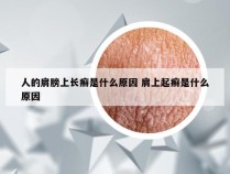 人的肩膀上长癣是什么原因 肩上起癣是什么原因