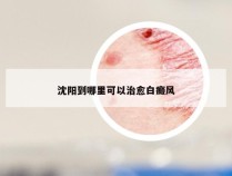 沈阳到哪里可以治愈白癜风