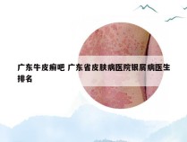 广东牛皮癣吧 广东省皮肤病医院银屑病医生排名