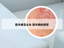 脸长癣怎么办 脸长癣的症状