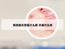 我到底长得是什么癣 长癣什么样