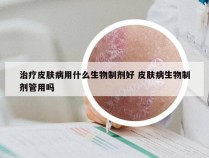 治疗皮肤病用什么生物制剂好 皮肤病生物制剂管用吗