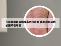 在成都治银屑病哪家医院最好 成都治银屑病的医院在哪里