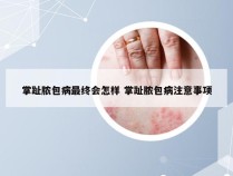 掌趾脓包病最终会怎样 掌趾脓包病注意事项