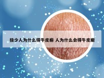 极少人为什么得牛皮癣 人为什么会得牛皮廨