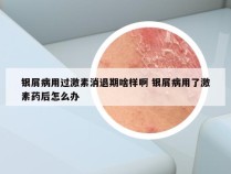 银屑病用过激素消退期啥样啊 银屑病用了激素药后怎么办