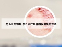 怎么治疗银屑 怎么治疗银屑病代谢慢的方法