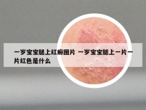 一岁宝宝腿上红癣图片 一岁宝宝腿上一片一片红色是什么