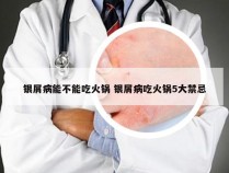 银屑病能不能吃火锅 银屑病吃火锅5大禁忌