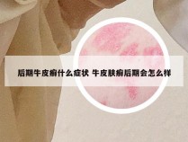 后期牛皮癣什么症状 牛皮肤癣后期会怎么样