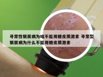 寻常性银屑病为啥不能用糖皮质激素 寻常型银屑病为什么不能用糖皮质激素